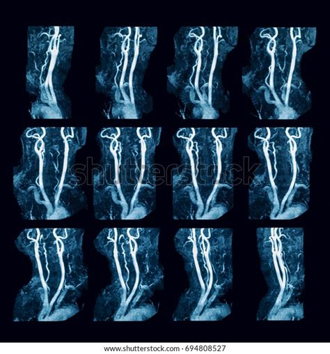 Magnetic Resonance Angiography Mra Neck Carotid Stock Photo Edit Now