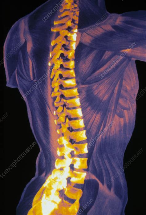 Coloured 3 D CT Scan Of The Human Spine Stock Image P116 0335