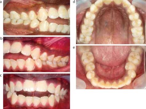 Maxillary Protrusion