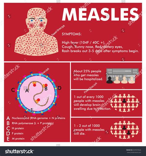 Vector Measles Infographic Symptoms Basic Statistics Stock Vector Royalty Free 257073526