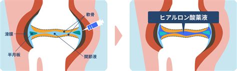 東京で膝関節症の再生医療・幹細胞治療なら青山レナセルクリニック