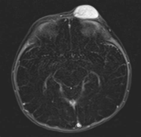 Scalp Hemangioma Image