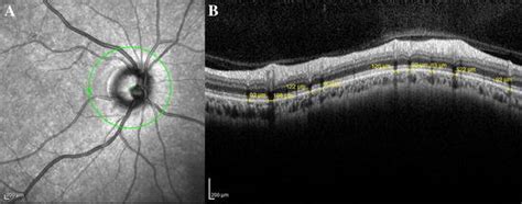 Image Of Retinal Vessel Diameter Measurement With Spectral Domain Oct A