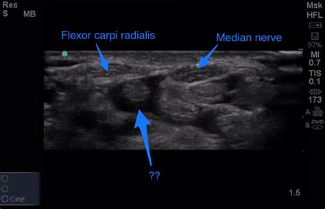 The Ultrasound Site Msk Ultrasound Training On Twitter We Re