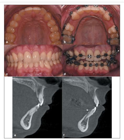 All About The Agga And More Adult Orthodontics Considerations Part One