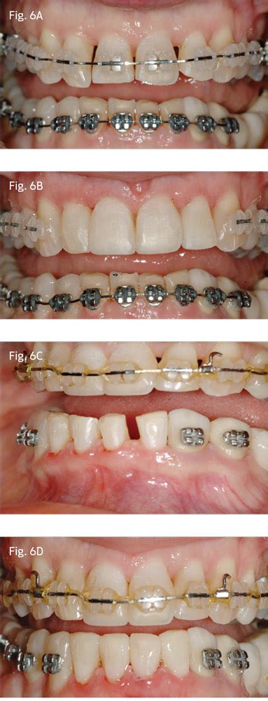 Effective Treatment Of Class Ii Deep Bite In Adult Cases By Dr Michel Di Battista Orthotown