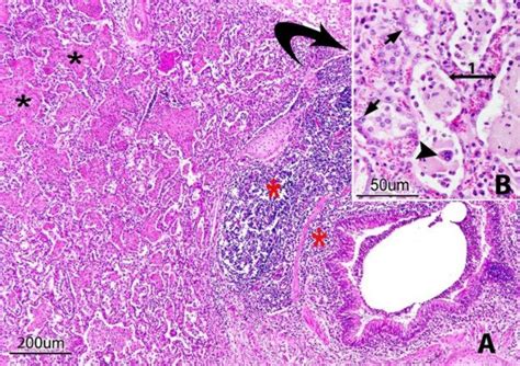 A Peribronchial Mononuclear Cell Infiltration In Case Of Brsv Infection