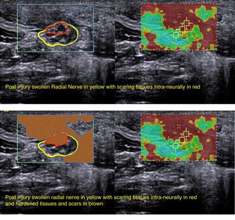 Figure 15 From Ultrasound Guided Nerve Hydrodissection For Pain Management An Updated Review Of