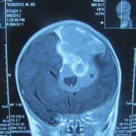 Preoperative CT scan showing a large solid-cystic left temporal lobe ...