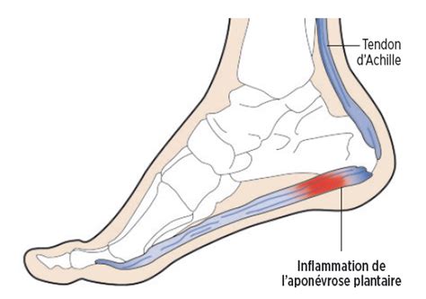 L Apon Vrosite Plantaire Fasciite Plantaire Ce Qu Il Faut Savoir