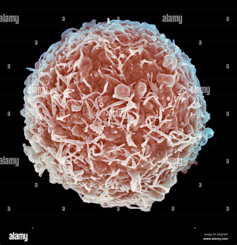 Cervical Cancer Cell Coloured Scanning Electron Micrograph Sem Of A