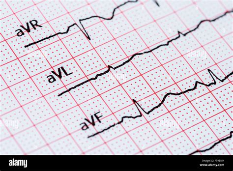 Sinus Heart Rhythm On Electrocardiogram Record Paper Showing Normal P