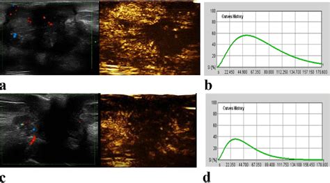 Figure 1 From Multiparametric Contrast Enhanced Ultrasound In Early