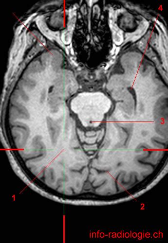 The Occipital Lobe - W-Radiology