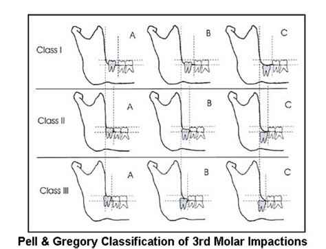 Impaction Classification – Exodontia