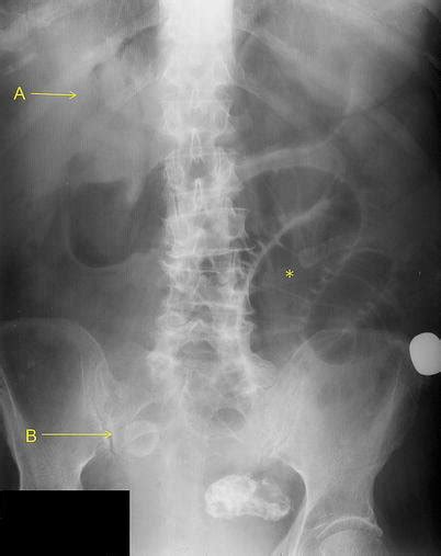 Plain Abdominal Radiograph Demonstrating Riglers Triad Pneumobilia