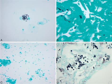 Figure 1 From Gomori Methenamine Silver Stain On Bronchoalveolar Lavage Fluid Is Poorly