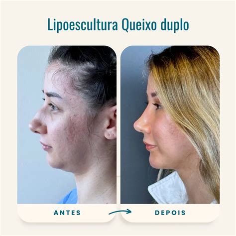 O Que É Lipoescultura - Lipoescultura Queixo duplo - iMed Medical