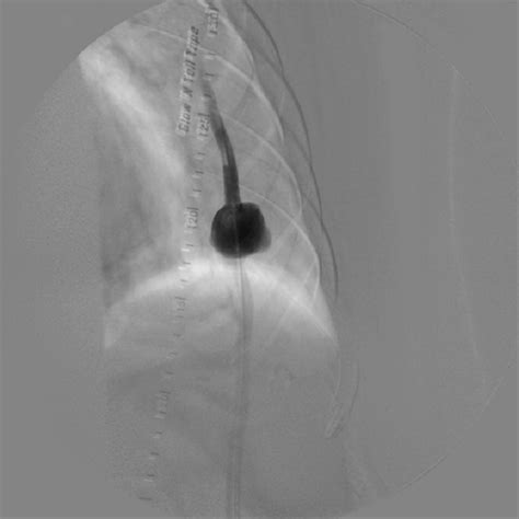 Chronic Traumatic Pseudoaneurysm Of Polytetrafluoroethylene Axillofemoral Bypass Graft In A