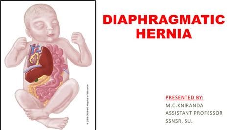 DIAPHRAGMATIC HERNIA .pptx