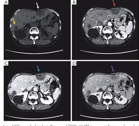 Figure 2 From Imaging Findings Of Hepatic Epithelioid