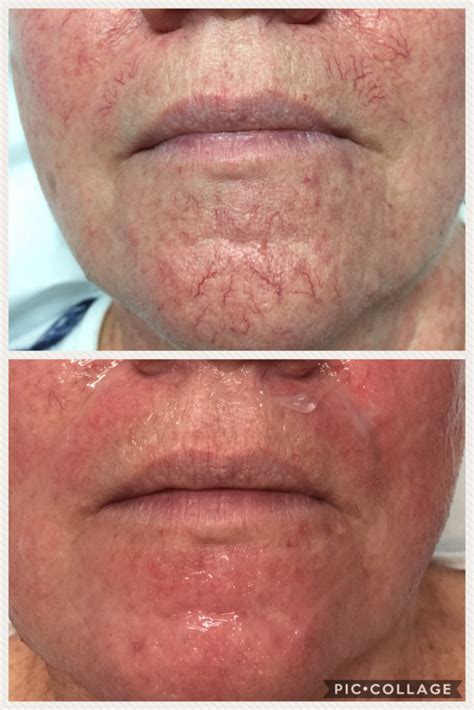 Ipl Acneredness And Pigment Reduction Holywood Private Clinic