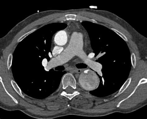 Aortic Dissection Ct Scan