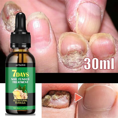 Days Ginger Nail Fungal Treatment Feet Care Essence Anti Infection