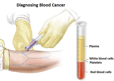 Blood Cancer Types Symptoms And Treatment