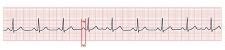 A Systematic Approach To Interpreting An Ecg Nursing Advanced Skills