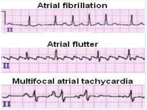 Afib And Atrial Flutter