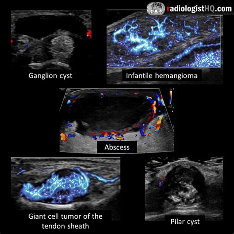 Ultrasound of soft tissue masses : r/Radiology