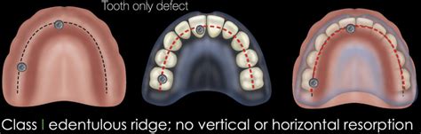 Zygomatic Implants Operative Consideration To Minimize Technical Errors