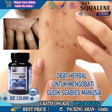 Jual Obat Gudik Scabies Manusia Gatal Bernanah Infeksi Kulit Scabies