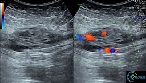 Scar endometriosis - drkalirajanscans