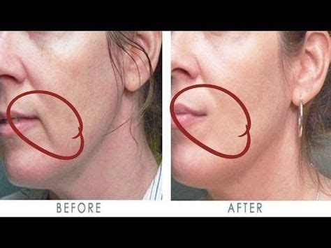 How To Remove Mouth Wrinkles In 3 Days Lift Corners Of Your Mouth