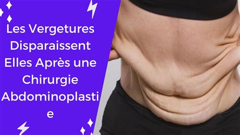 Les Vergetures Disparaissent Elles Après une Chirurgie Abdominoplastie