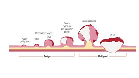 Fecal Dna Testing Can Help Early Detection Of Colorectal Cancer