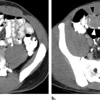 Ileoileal Intussusception And Small Bowel Obstruction Caused By An