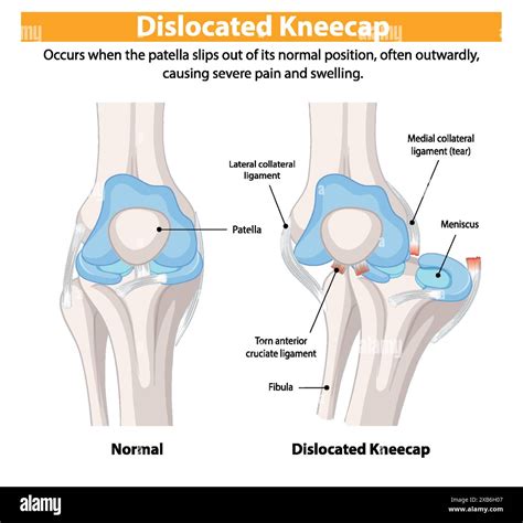 Comparison Of Normal And Dislocated Kneecap Stock Vector Image Art