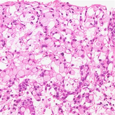 Figure1 Gastric Signet Ring Cell Carcinoma Admixed With A