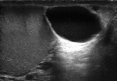 Ultrasound Of The Scrotum