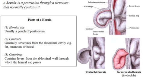 Hernias Flashcards Quizlet