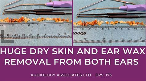 Huge Dry Skin And Ear Wax Removal From Both Ears Ep173 Youtube