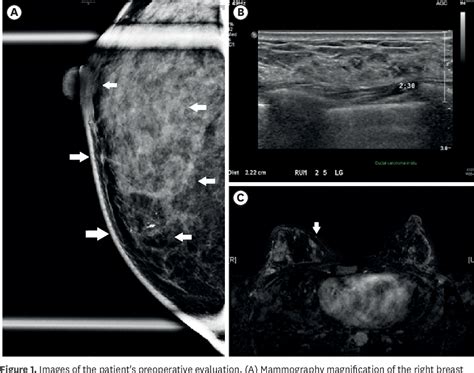 Figure 1 From Development Of Robotic Mastectomy Using A Single Port