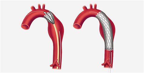 Interventional Cardiology Procesures