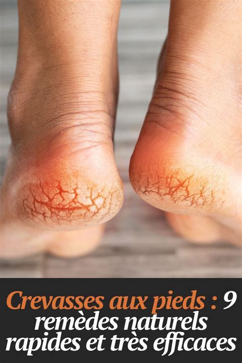 Crevasses aux pieds 9 remèdes naturels rapides et très efficaces