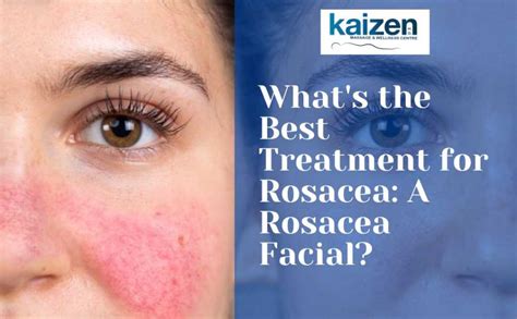 Best Treatment For Rosacea Benefits Of A Rosacea Facial