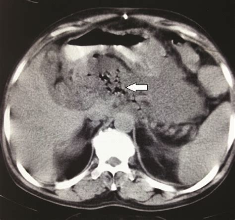 Cect Abdomen Six Weeks Prior To Presentation Showing Acute Necrotising