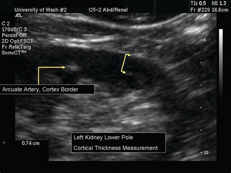 Renal Cortex Ultrasound